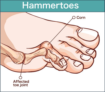 102830971_S_hammertoe_illustration_corn.jpg