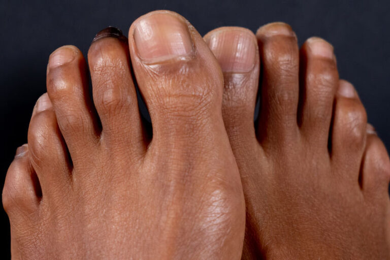 WHAT IS A HAMMERTOE?