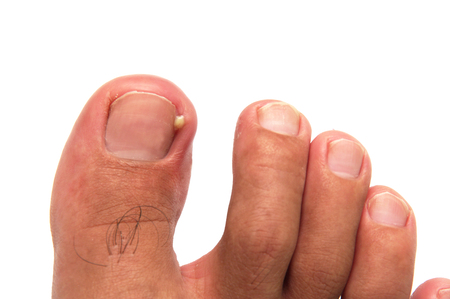 61379021_S_infection_ingrown_toenail_man_foot_puss_yellow_pain.jpg