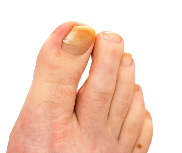 Understanding Nail Fungus: How It Lives and How Treatment Works