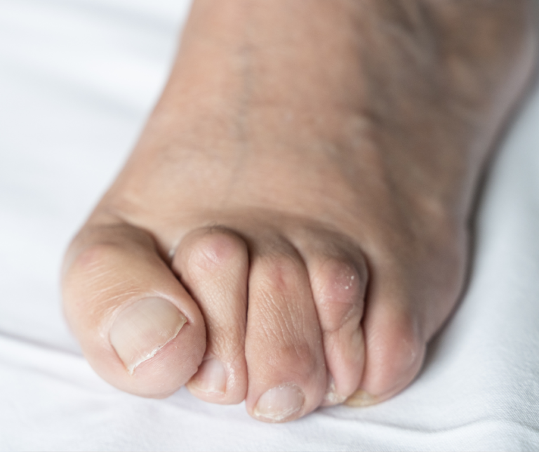 Minimally Invasive Surgery for Flexible Hammer Toes: The Percutaneous Tenotomy Solution