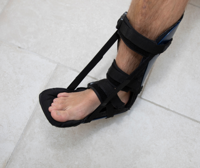 Why and How Posterior Night Splints Work for Achilles Tendonitis and Plantar Fasciitis