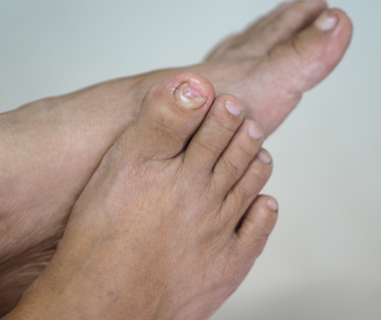 Early Intervention for Fungal Toenail Infections: Why Acting Fast is Key to Successful Treatment