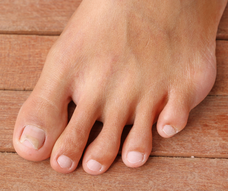 How Lymphedema Affects Your Toenails