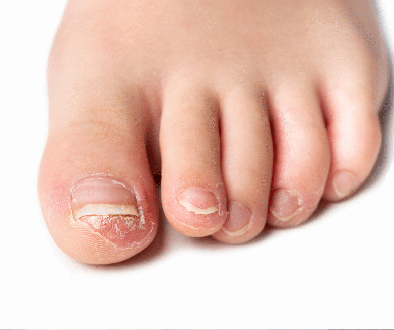 Home Care for Fungal Toenail Treatment: How to Improve Nail Health & Prevent Reinfection