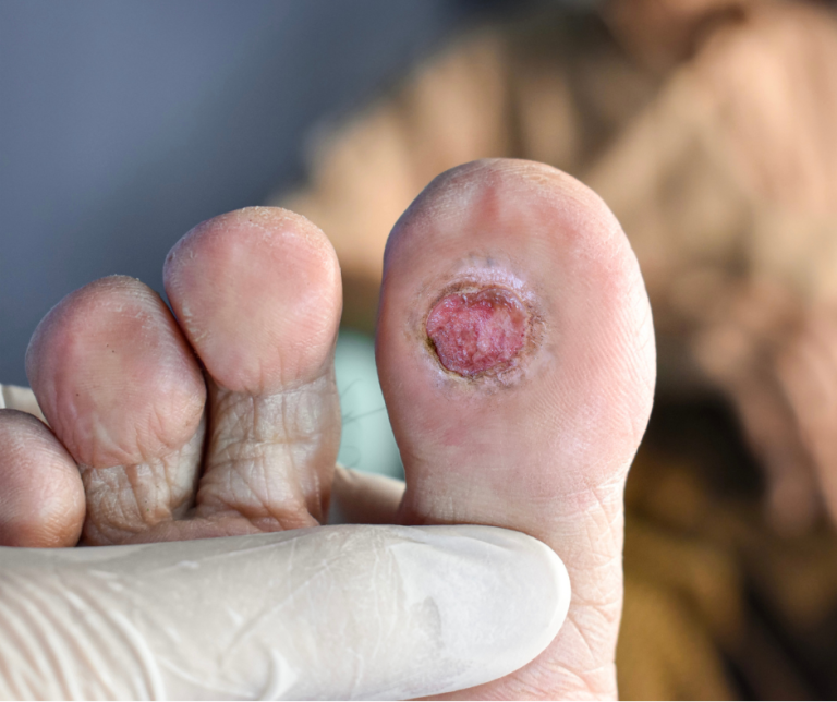Foot with ulcer on bottom of big toe