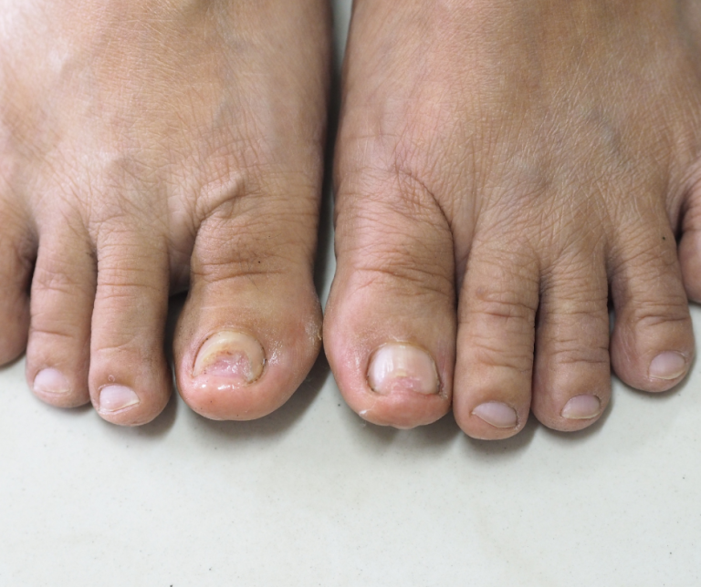 How Onyfix Can Help Repair Nail Trauma—and Support Fungal Nail Treatment