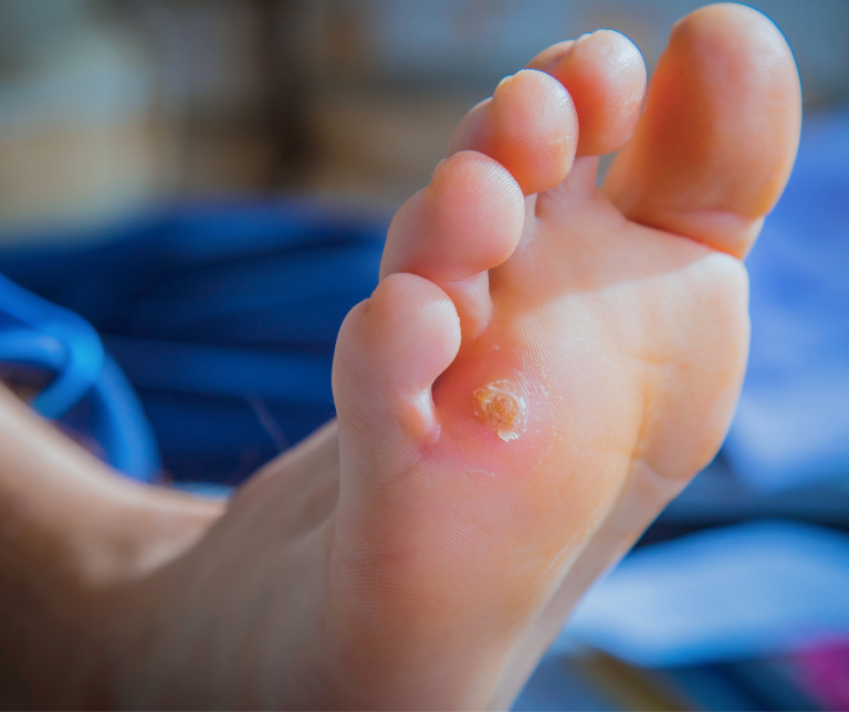 Plantar Warts vs Calluses: How to Tell the Difference (and Why It Matters)