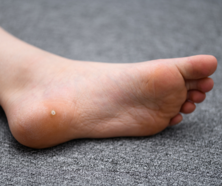 Swift Microwave Therapy for Warts: A Smarter Way to Treat Them