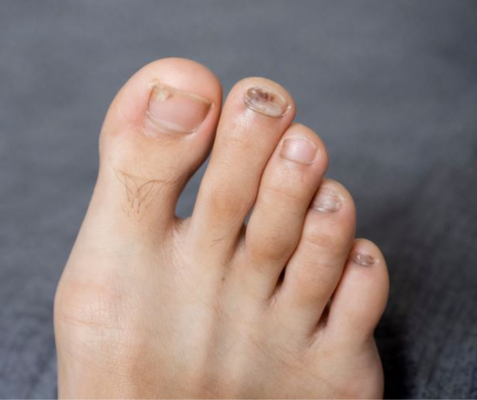 toenail fungus