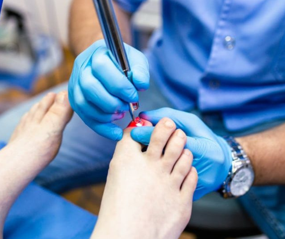 toenail laser treatment