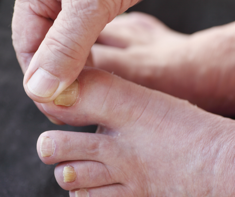person with yellow toenails
